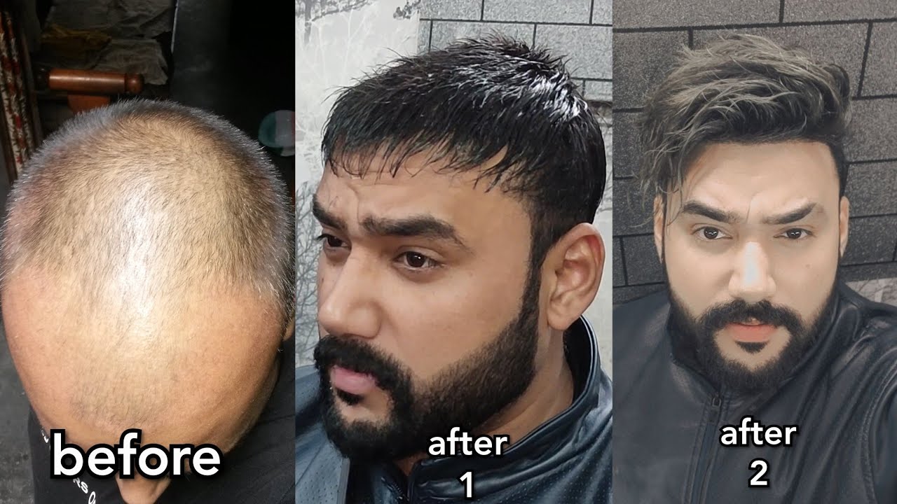 low density vs heavy density results ( 9888015815 ) hair patch punjab