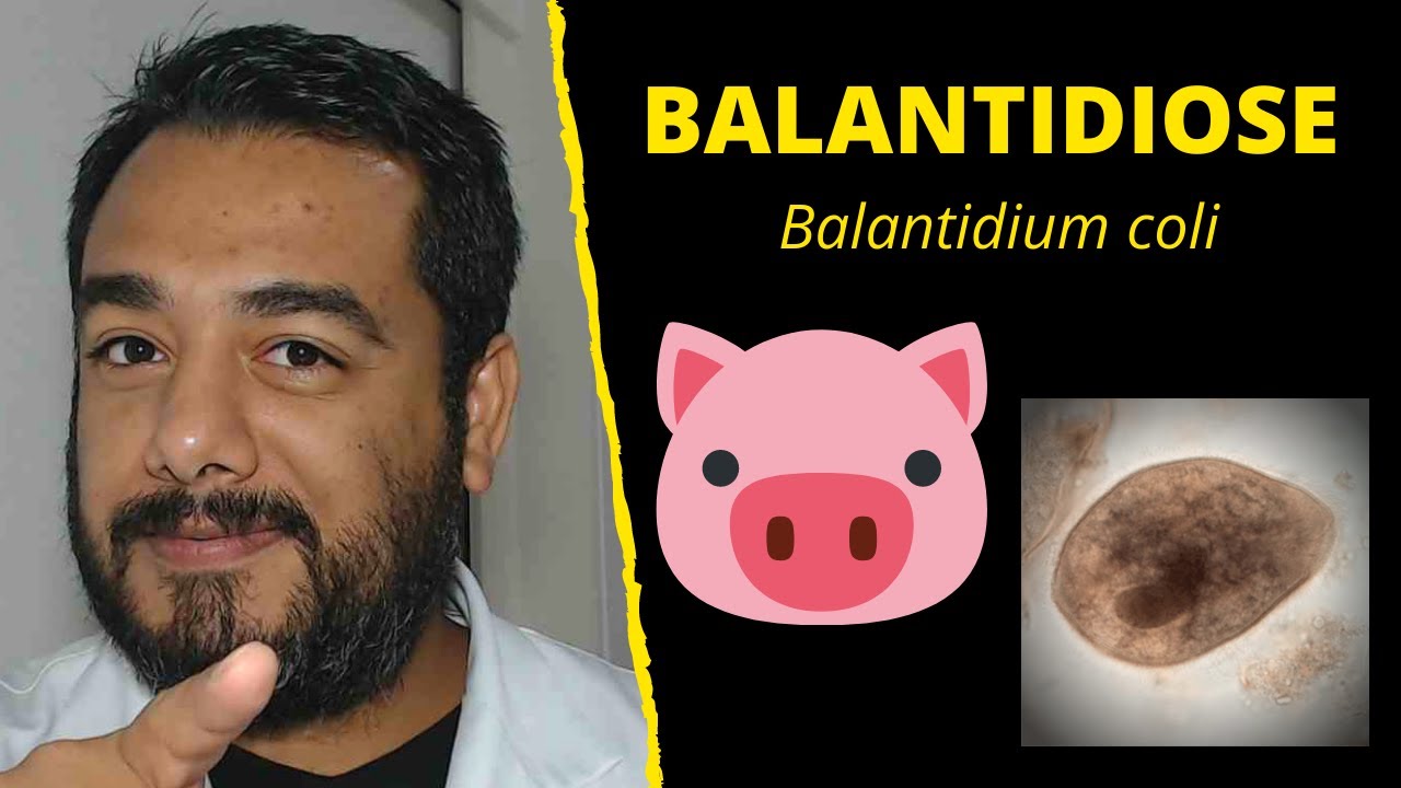 Balantidiose (Balantidium coli) | Curso de #Parasitologia Humana Básica e Clínica | IBAP Cursos