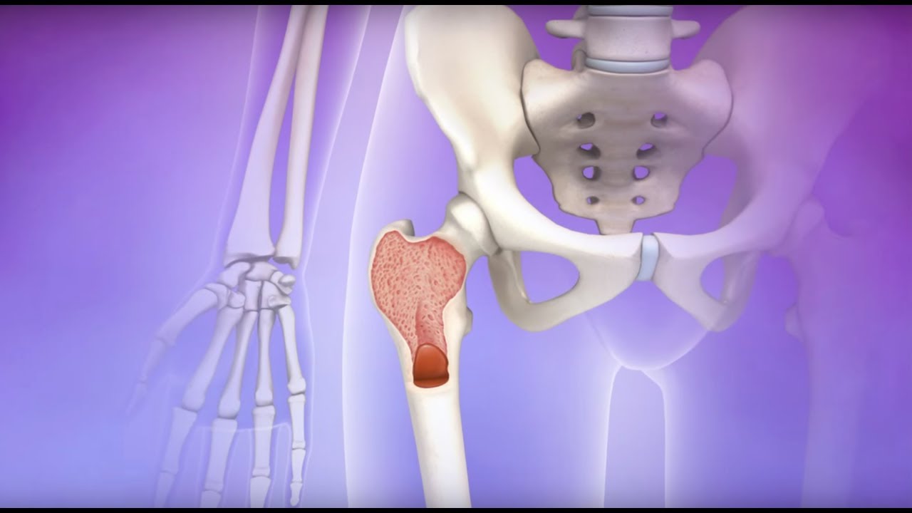 Myelofibrosis - Mayo Clinic