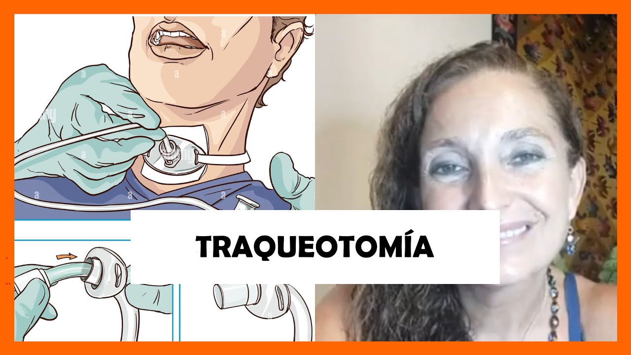 Paciente Con Traqueotomia: Tecnicas De Fisioterapia Respiratoria