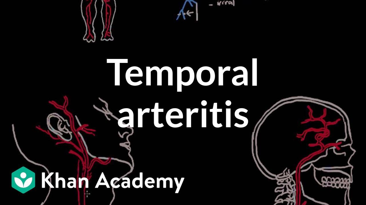 Temporal arteritis | Circulatory System and Disease | NCLEX-RN | Khan Academy