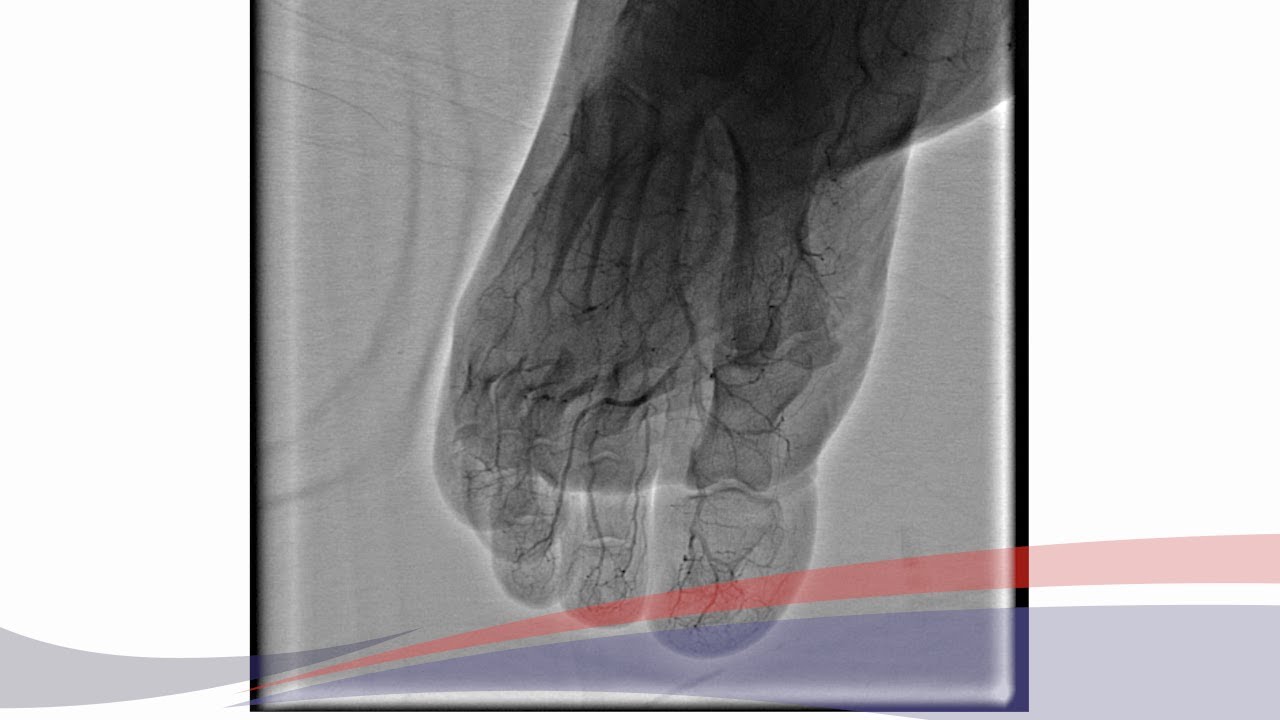ANGIOPLASTIA PERIFÉRICA COMPLEJA A OCLUSIÓN DE BYPASS FEMORO TIBIAL