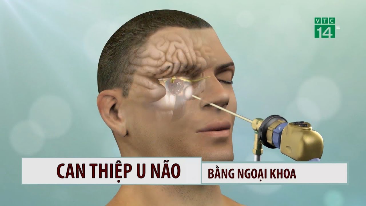 Can thiệp u não bằng ngoại khoa| VTC14