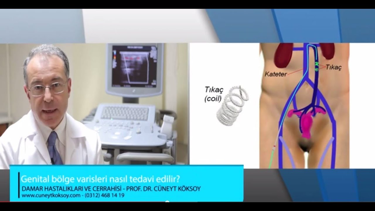 Prof.Dr. Cüneyt Köksoy - Genital Bölge Varisleri Nasıl Tedavi Edilir?