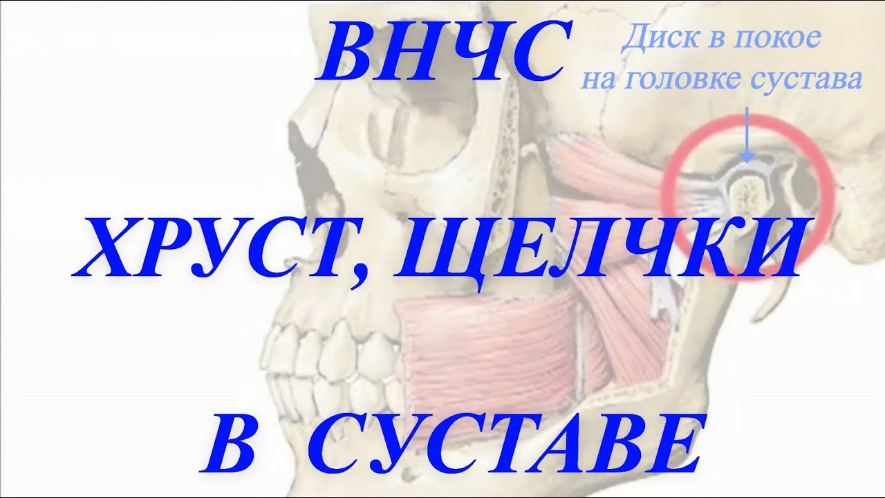 Хрустит и щёлкает нижняя челюсть. #Остеоартроз , передний вправляемый вывих диска.