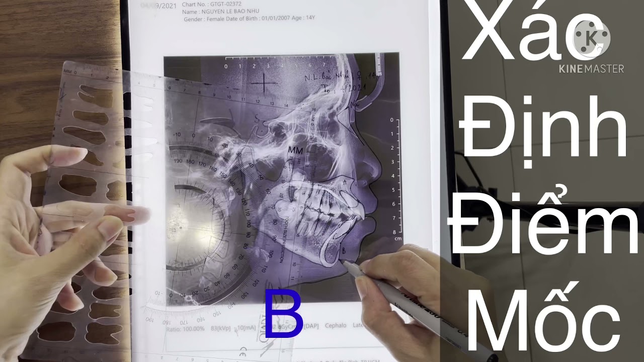 Bác sĩ RHM làm gì? Phần: Phân tích phim X quang