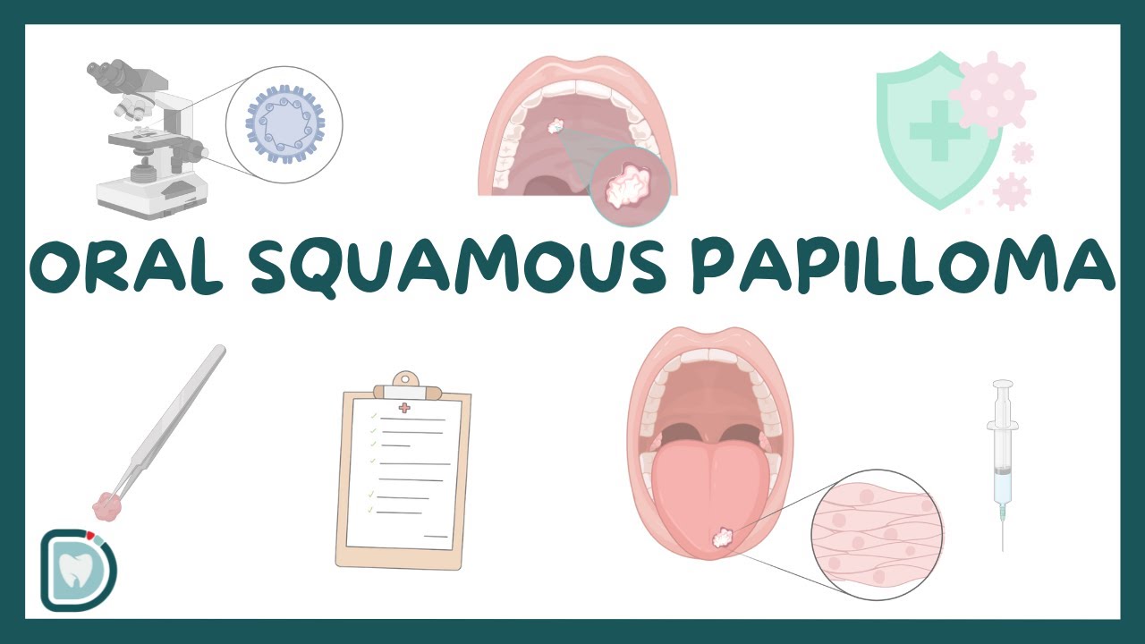 Oral Squamous Papilloma: Causes, Diagnosis, Types, and Management