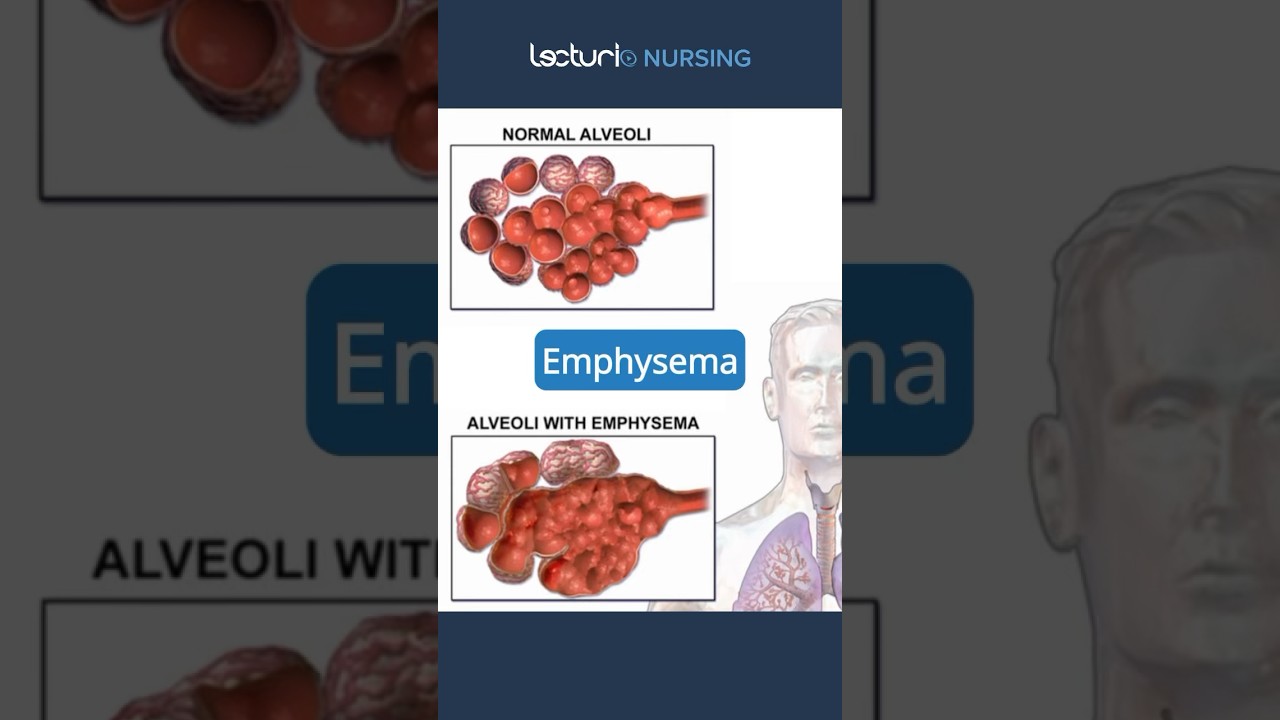 Exploring Emphysema 🔍 #Emphysema #RespiratoryCare #nclexrn