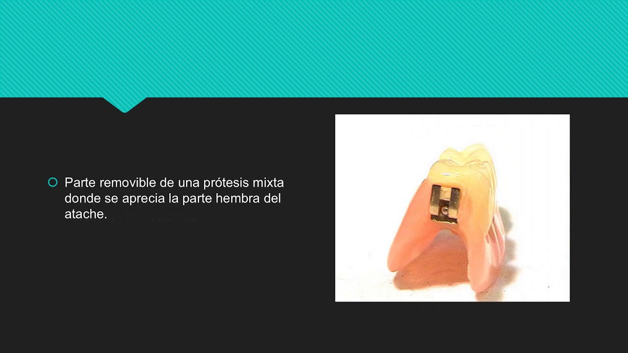 PR&Ograve;TESIS MIXTA(Mecanica dental)
