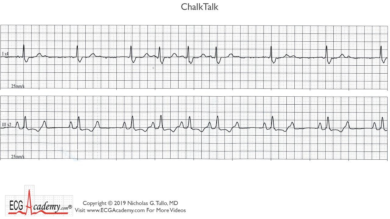 Irregular Heartbeat Challenge - ChalkTalk380