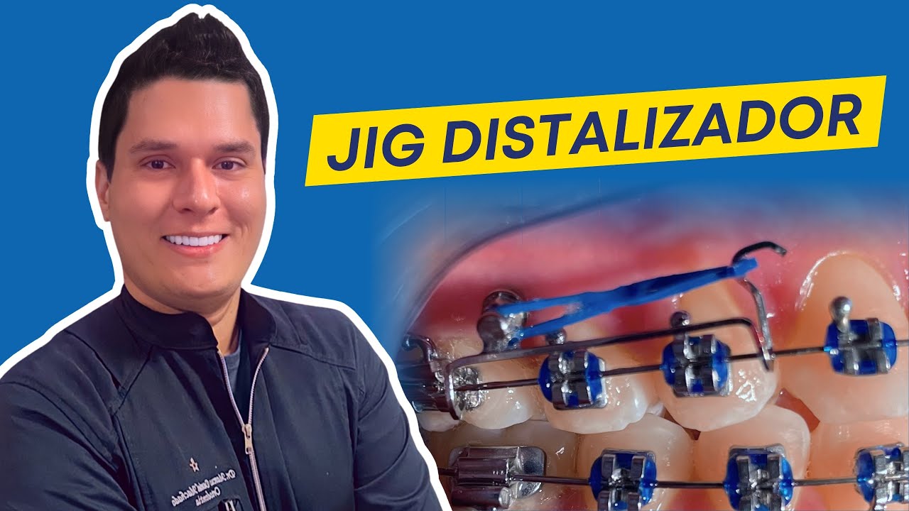 CONFECÇÃO DO JIG DISTALIZADOR - SLIDING JIG (PASSO A PASSO).