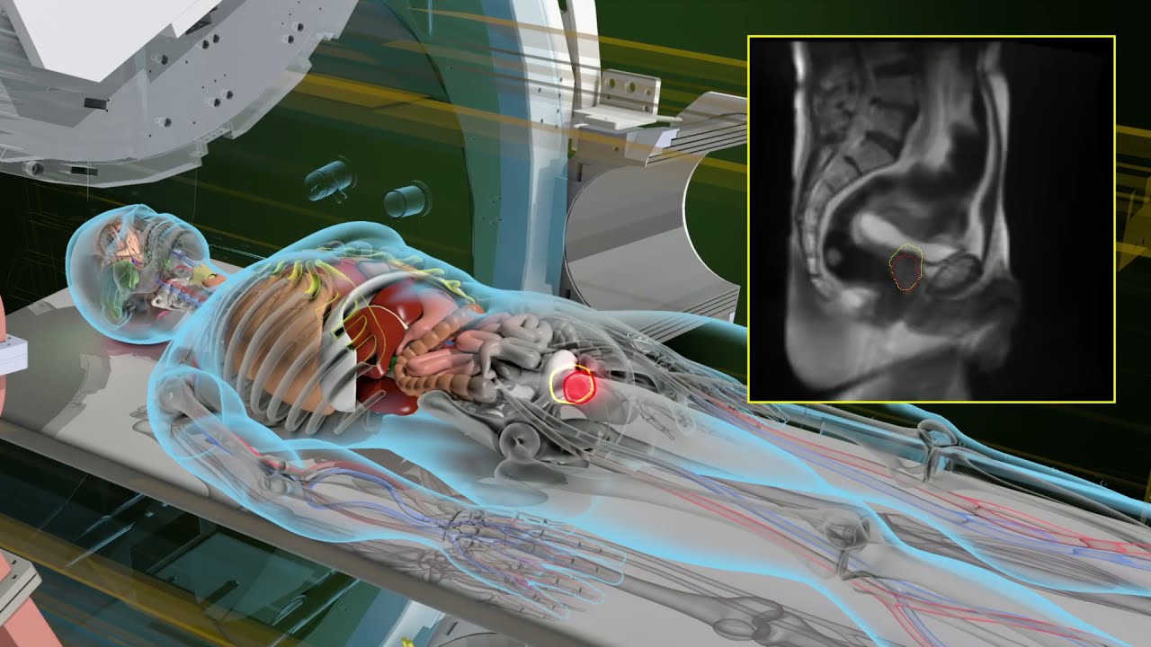 ViewRay MRIdian MR linac explained