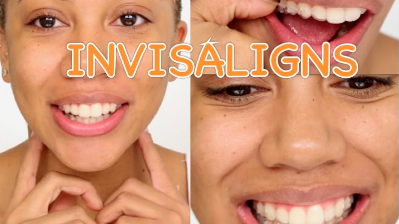 I GOT INVISALIGNS! | PRICES | COMFORT + MORE | FaceOverMatter
