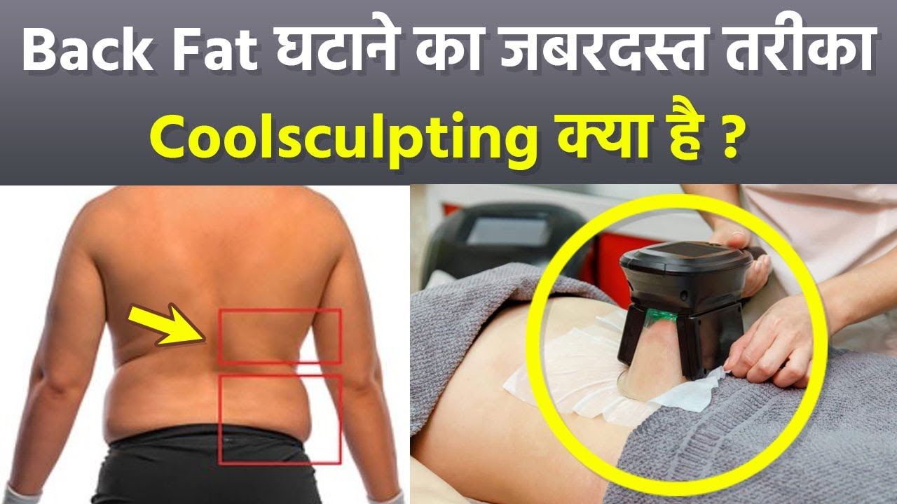 Coolsculpting Treatment For Weight Loss: Back Fat Reason and Remedy in Hindi|Boldsky