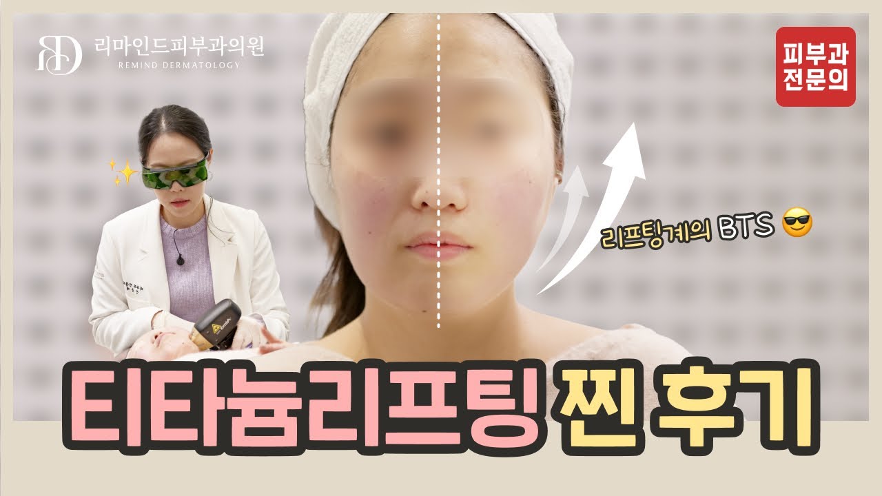 턱선이 이렇게 달라진다고? 티타늄 리프팅 시술 찐 후기😮✨