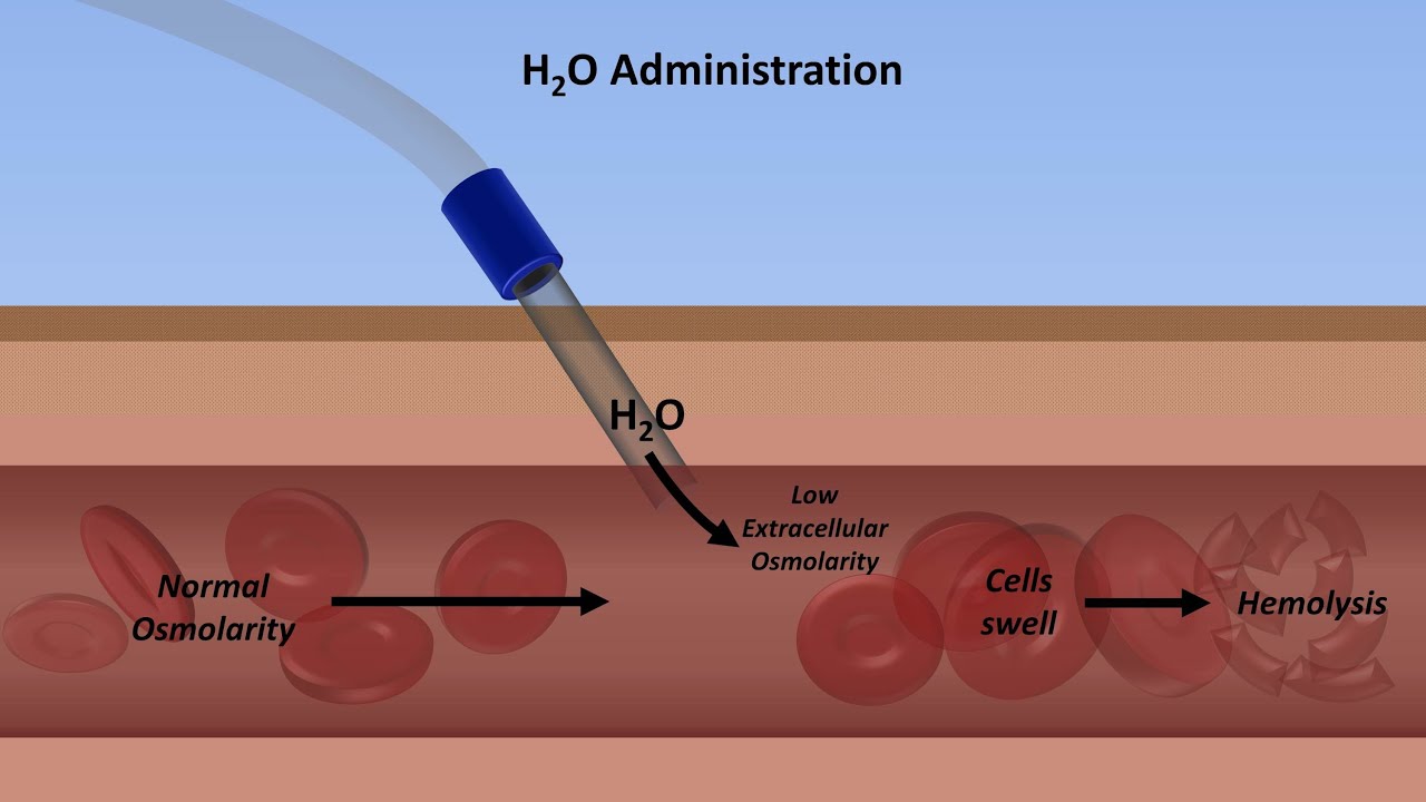 Hypernatremia