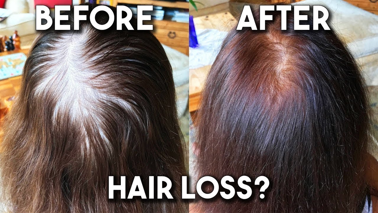 Thinning Hair? New Technology | HairMax LaserBand 82 to Regrow Hair
