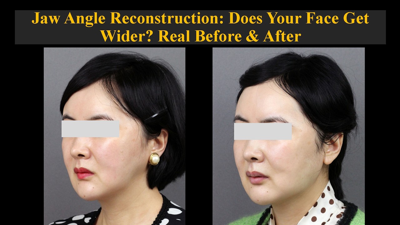 Jaw Angle Reconstruction: Does Your Face Get Wider? Real Before & After