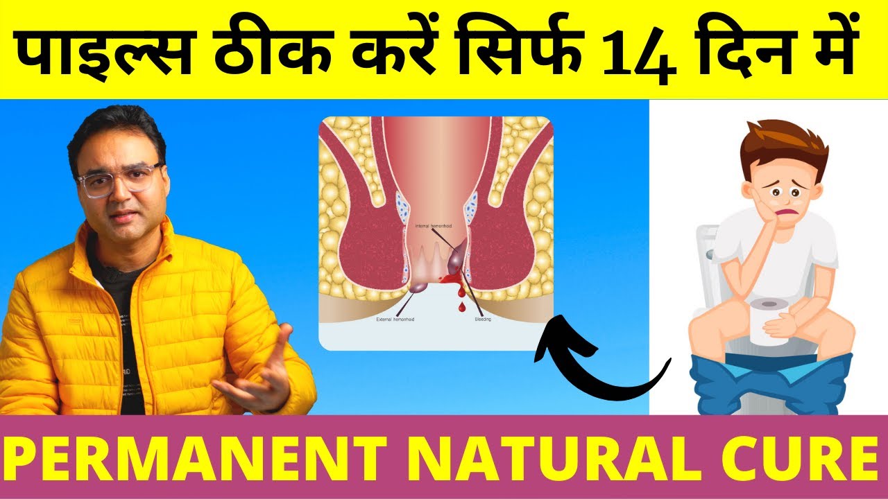 Piles Treatment: पुराने से पुराना पाइल्स (बवासीर) 14  दिन में जड़ से ठीक करें | Piles Home Treatment
