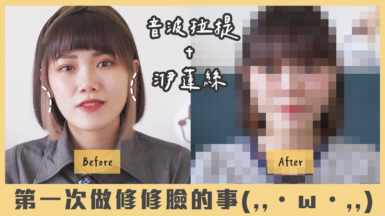 【Vlog】我去微整啦！改善初老凹凹臉｜彩蝶音波+洢蓮絲