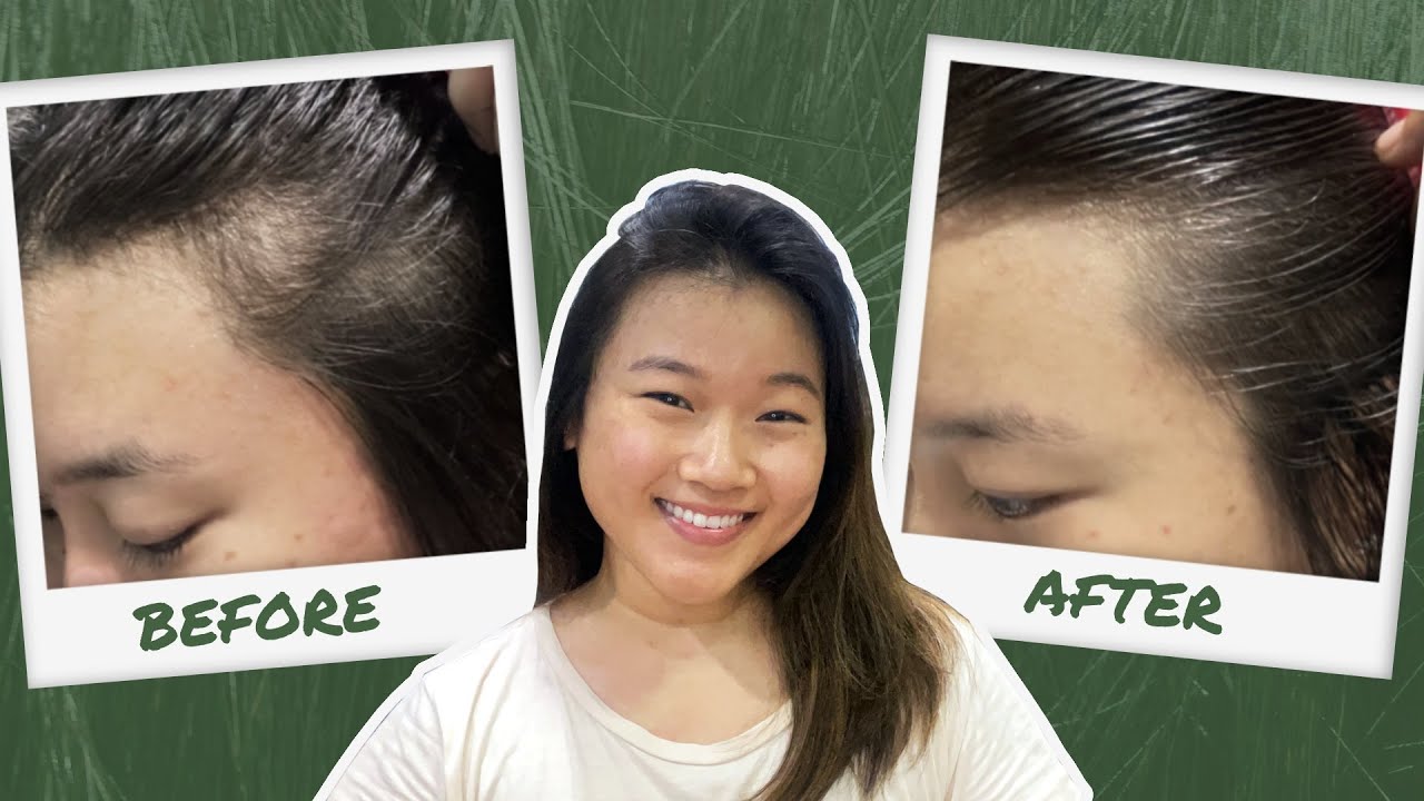 How I Fixed My Thinning Hair | Hairmax Laserband 82 Review with Before & After Results