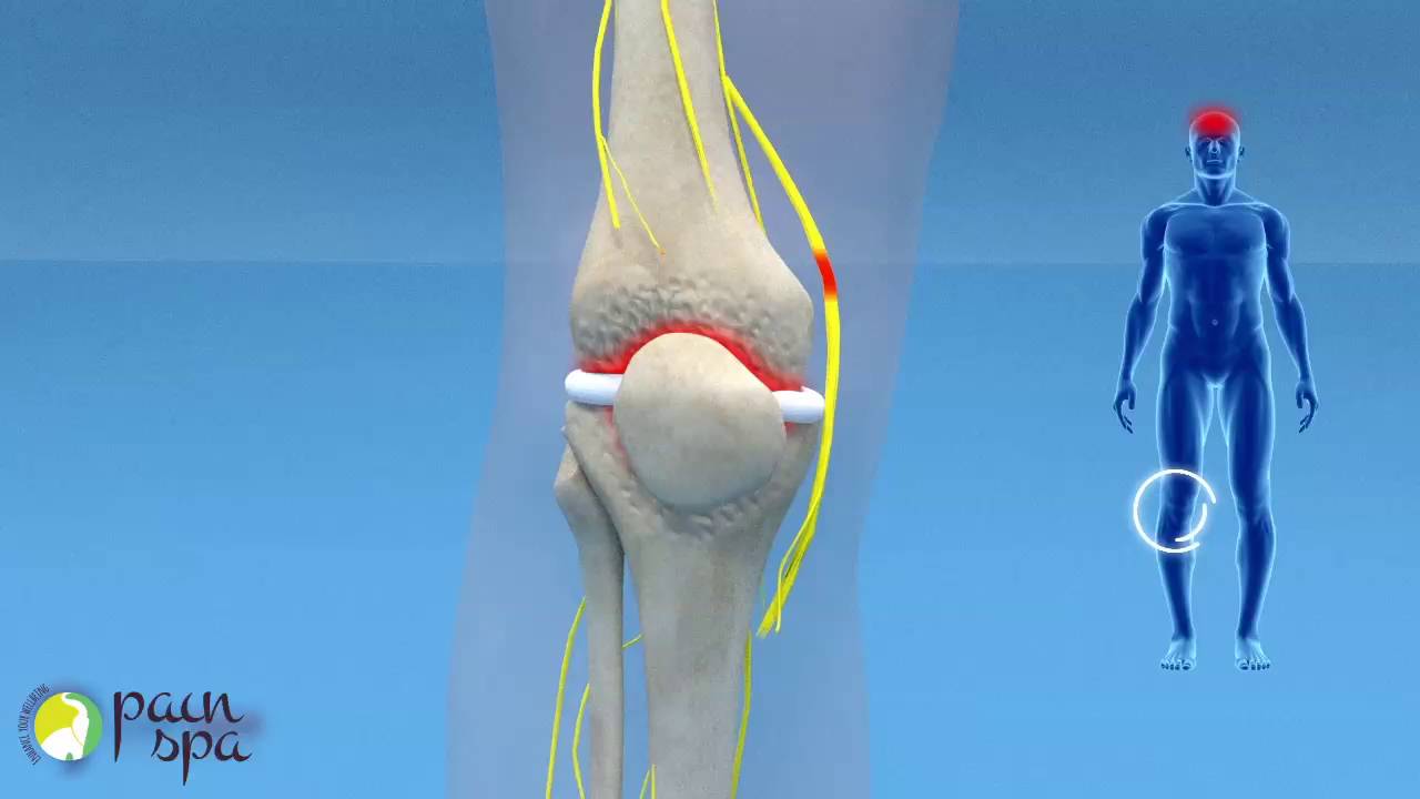 COOLIEF: Genicular nerve block and radiofrequency of the Knee Joint