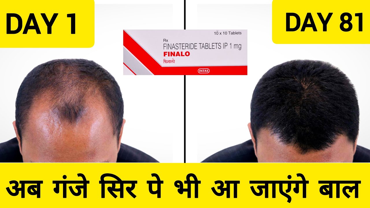 Finasteride 1mg Review | Finalo Tablet | Finasteride 1mg Results | Finasteride 1mg Tablets