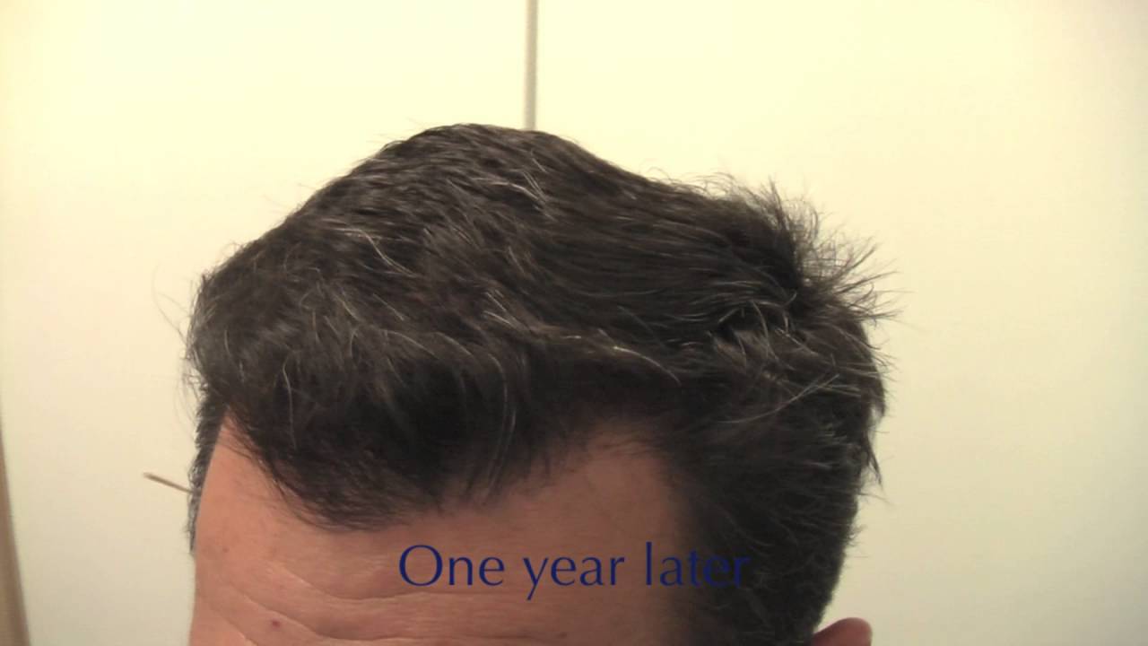 Frontal Fullness. High-Definition Hairline with 2343 grafts. Carlos K. Wesley, M.D. (NYC)