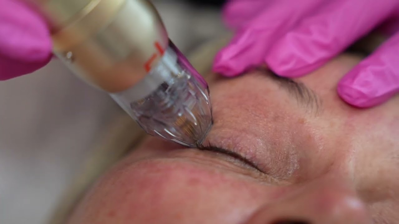 Lift Your Eyes, Lift Your Spirit: Non-Surgical Eyelid Tightening with Sylfirm X RF Microneedling