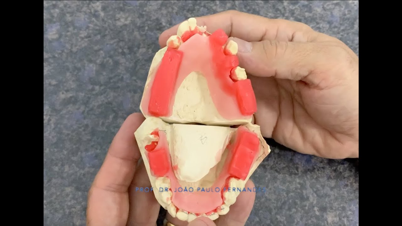 Plano de cera para Relação Maxilomandibular