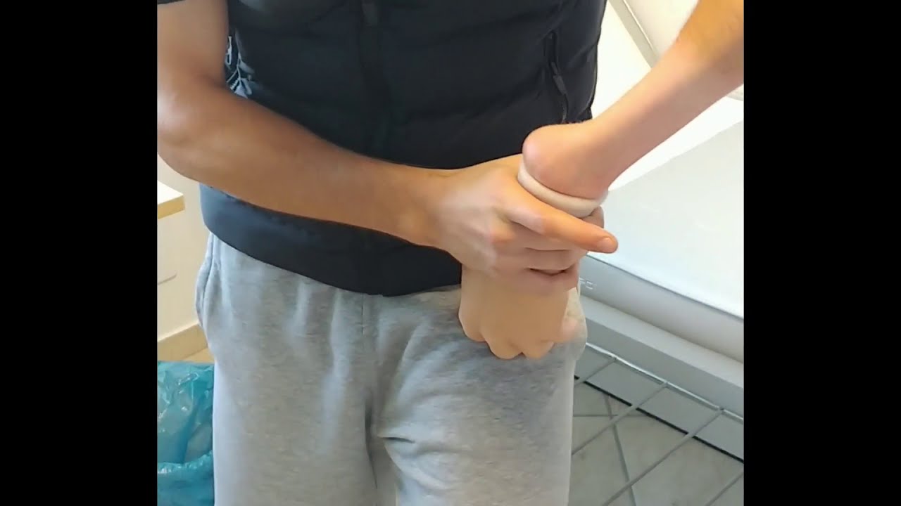 Protesi di mano realizzata con tecnologia 3D, invasatura e Cosmesis in silicone