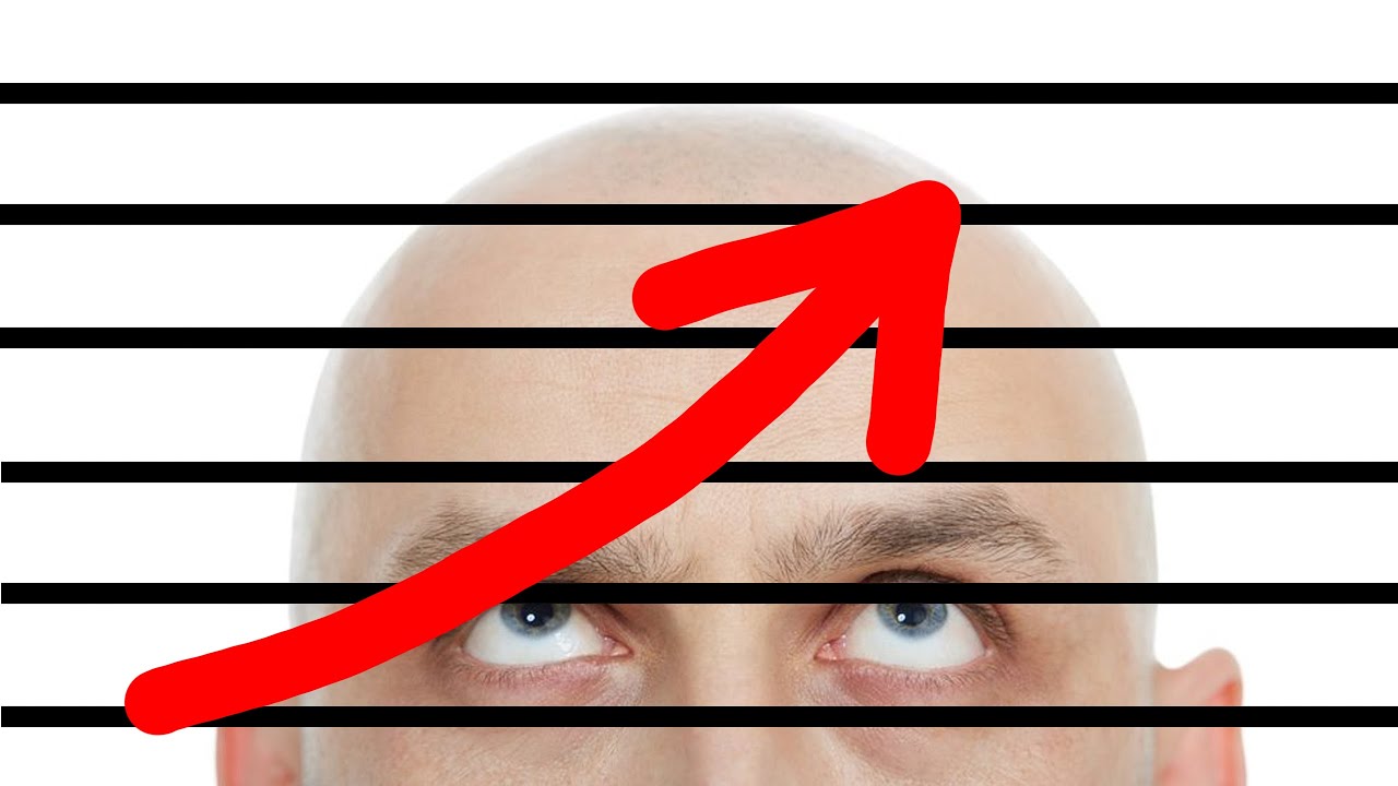 Cada vez somos más calvos ¿Se puede prevenir?