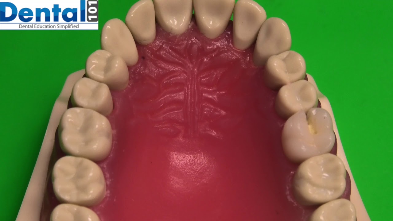 How to assess Caries task?