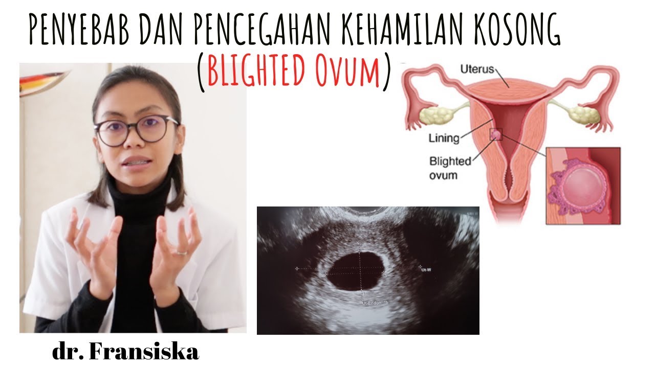 HAMIL KOSONG ATAU BLIGHTED OVUM (BO) | APA PENYEBABNYA DAN PENCEGAHANNYA ?