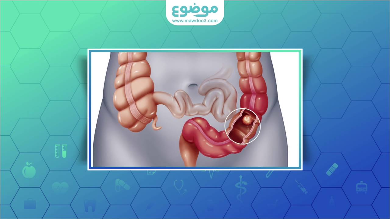 موضوع أنواع التهاب القولون وأعراضه