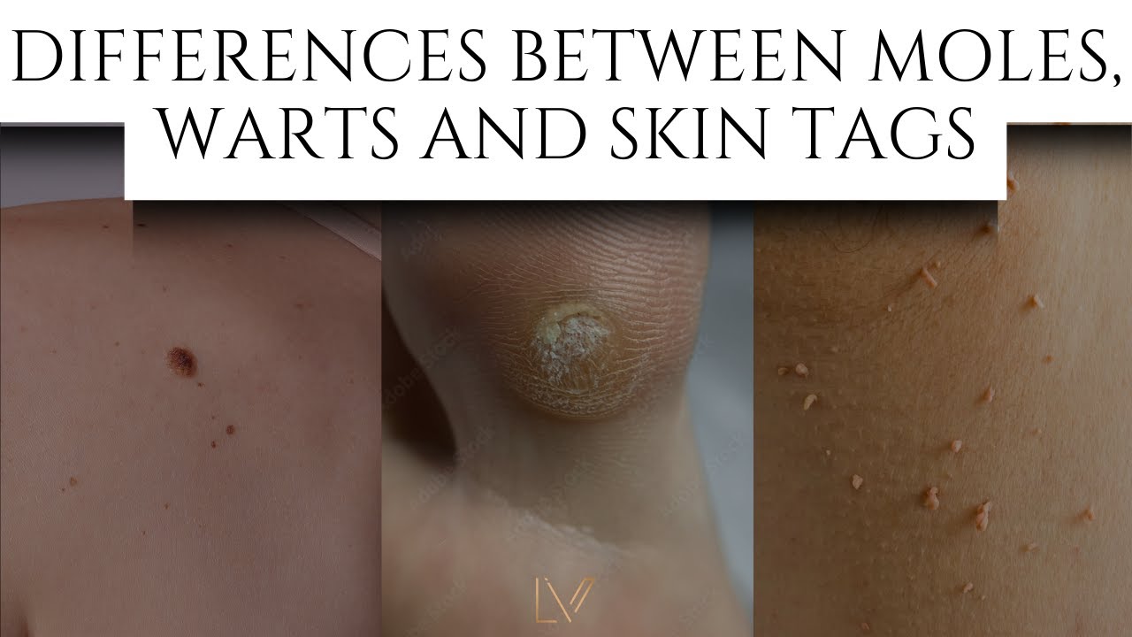 Differences Between Moles, Warts and Skin tags #skincare