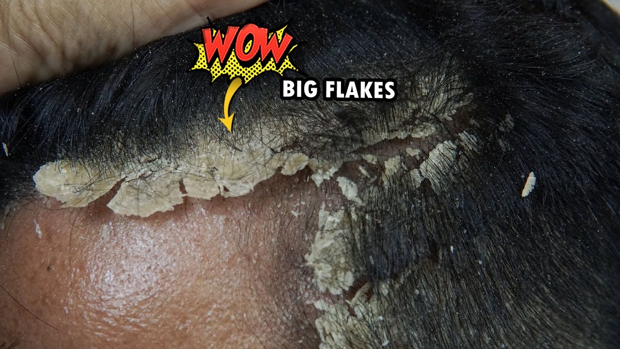 Dandruff Combing Big Flakes #1055