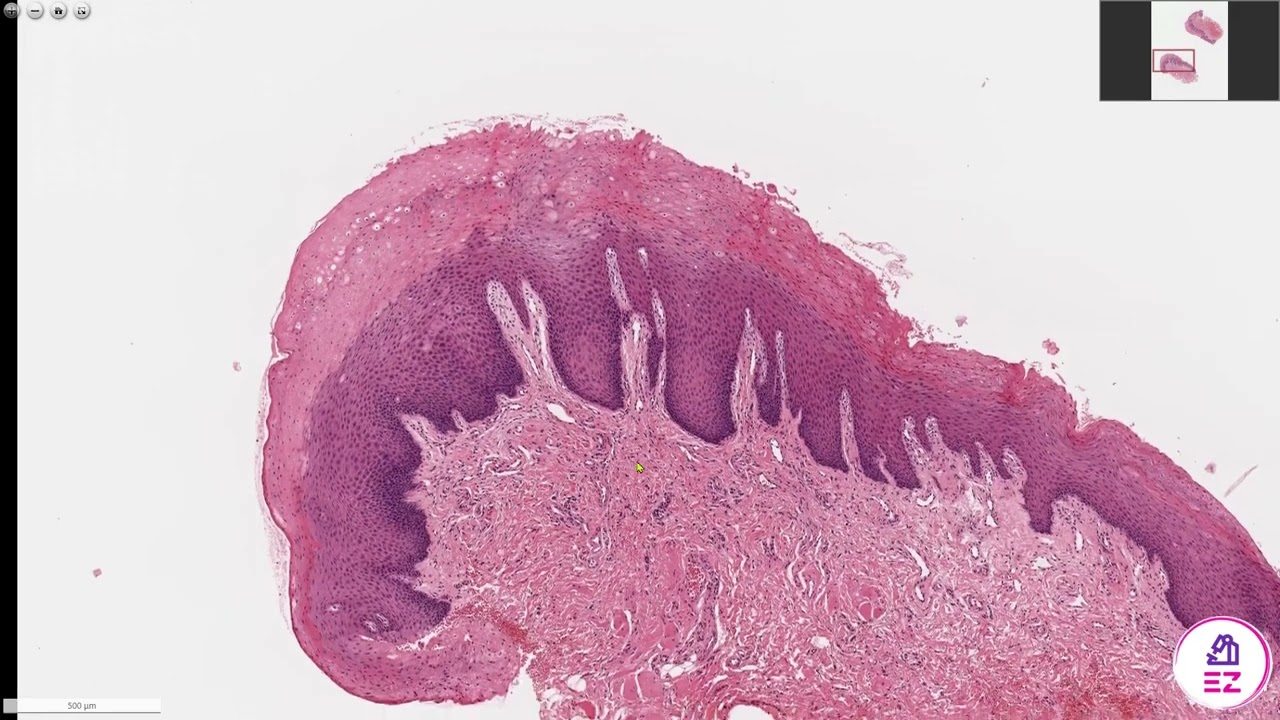 Hyperkeratosis