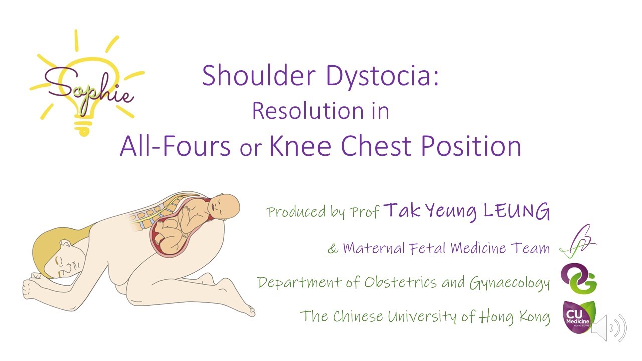 Shoulder Dystocia : Resolution in All-Fours or Knee Chest Position - OBG CUHK