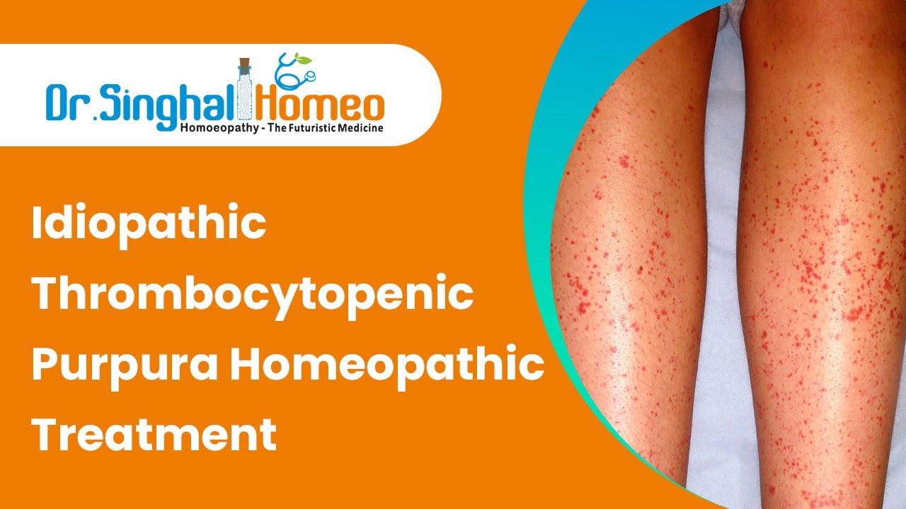 Homeopathic Treatment for Falling Platelet Count - Idiopathic Thrombocytopenic Purpura