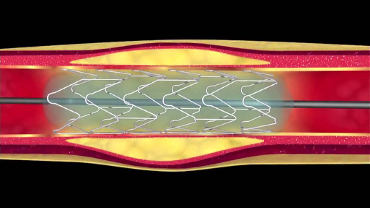 Coronary angioplasty
