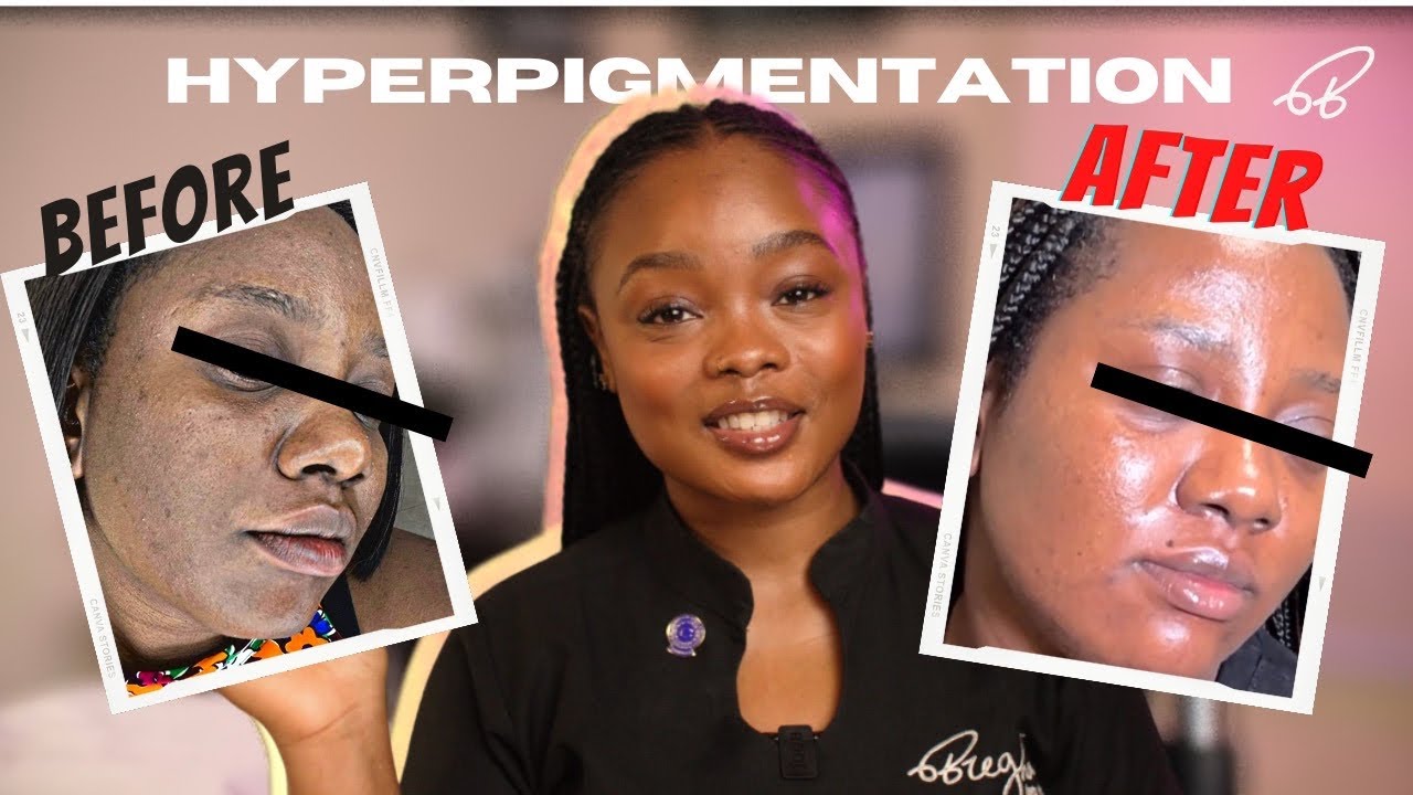 Effective treatment for Hyperpigmentation!
