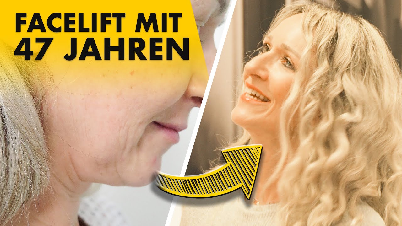 Nachkontrolle 4 Monate nach Facelift! | Dr. Jungwirth