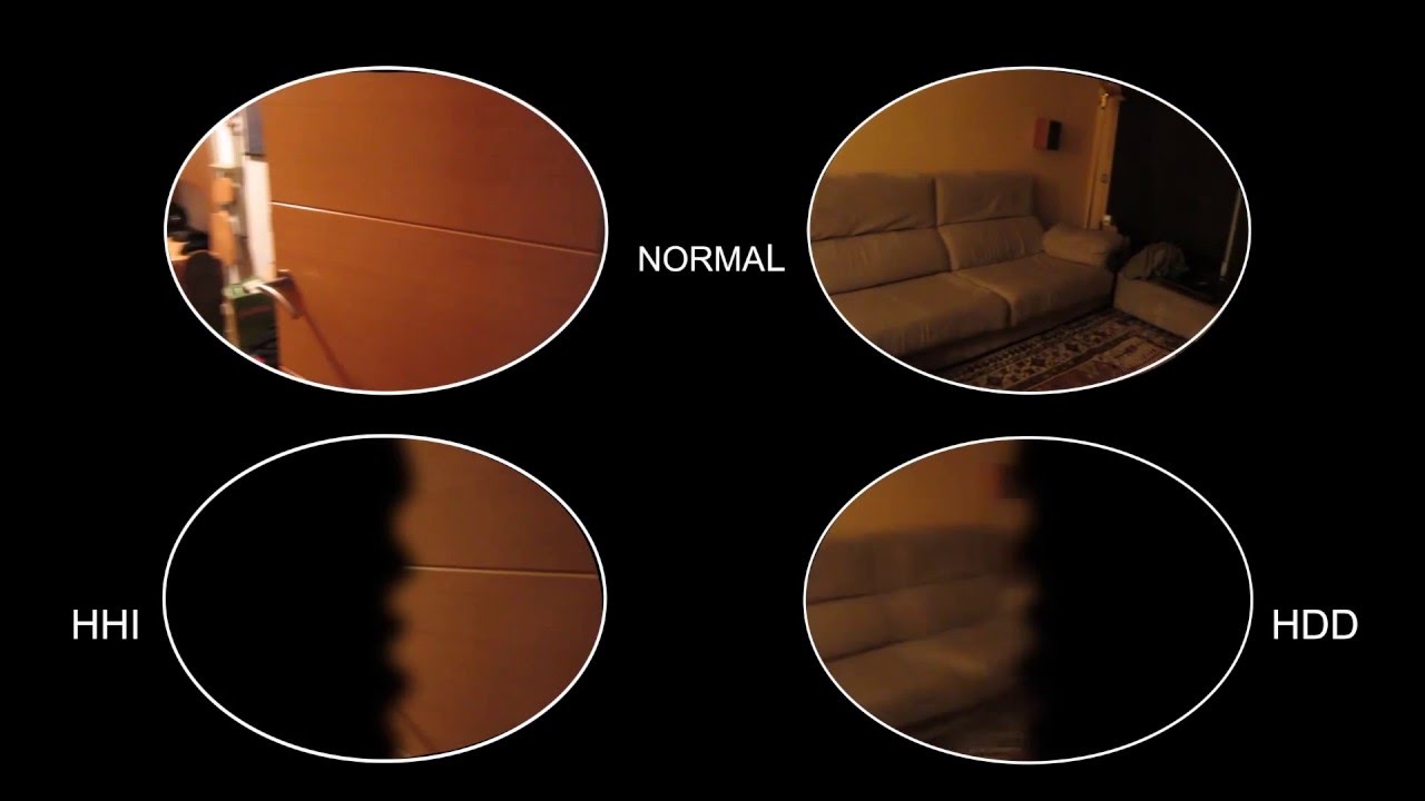 HEMIANOPSIA: REHABILITACION CON LOS PRISMAS EN BANDA DE PALOMAR