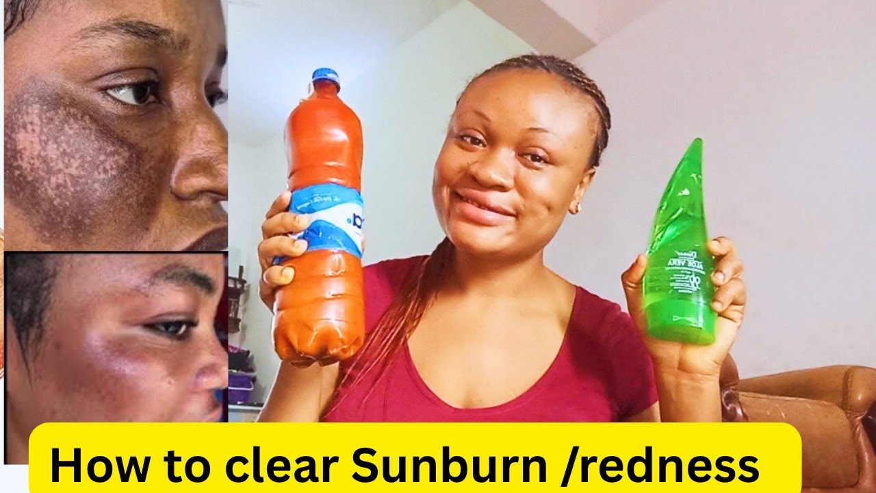 The Most Effective SUNBURN Remedy in the world💯 How to clear Sunburn and facial Redness 