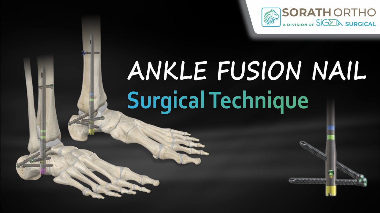 Ankle fusion nail surgical technique.