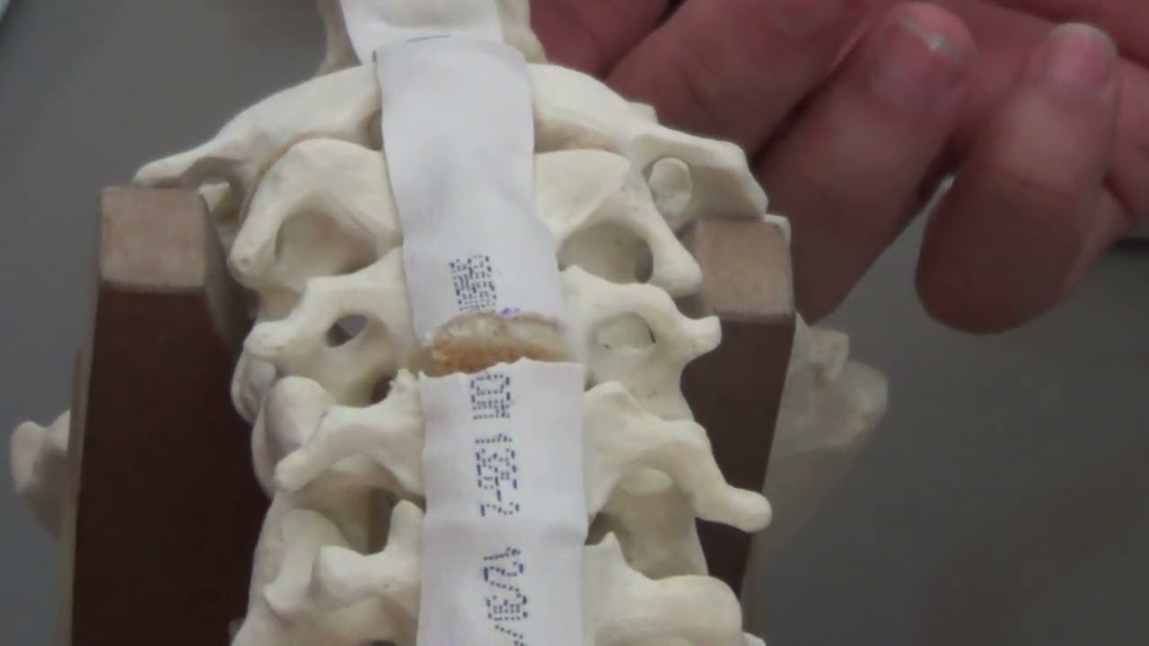 APSS Workshop : Anterior Cervical Discectomy and Fusion ACDF (3)