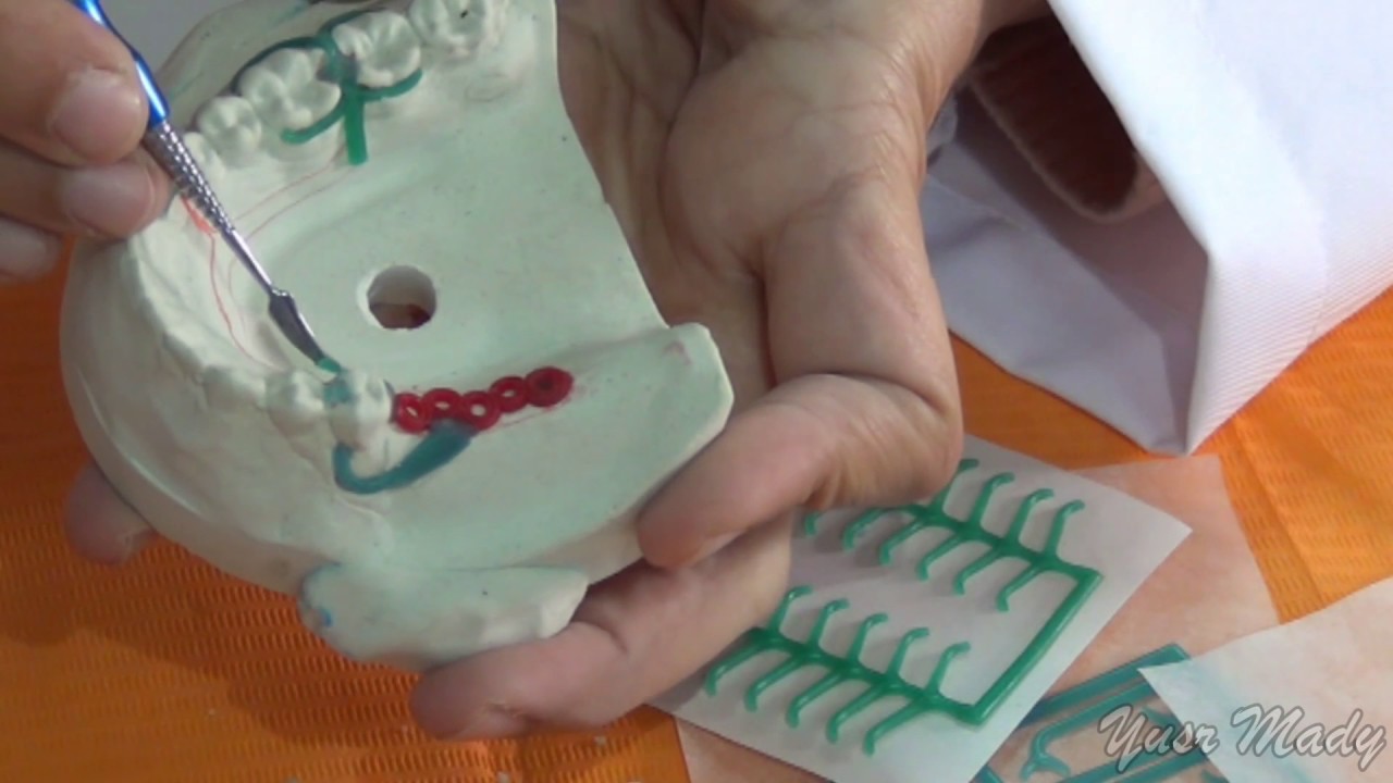 7- Wax Pattern (Mandibular  Class II)