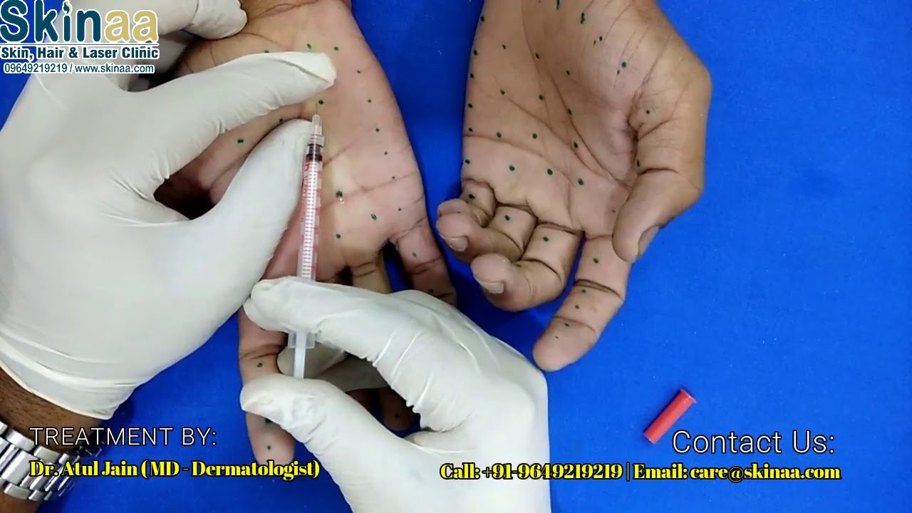 Botox Therapy for Palmer Hyperhidrosis (Sweaty Hands) | Skinaa Clinic, Jaipur