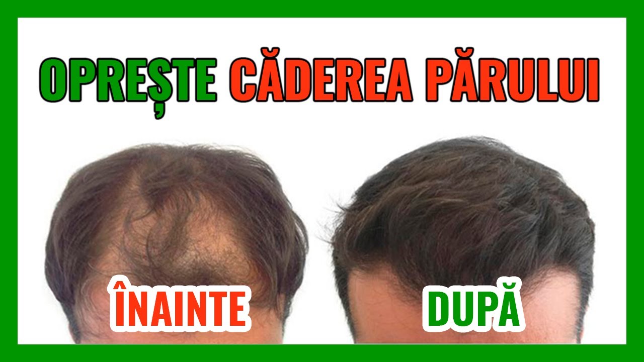 CADEREA PARULUI - TRATAMENT SI REMEDII IMPOTRIVA CADERII PARULUI